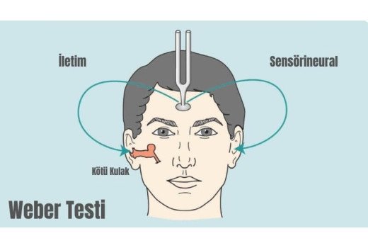 Weber Testi Nedir? Tanım, Köken ve Klinik Amaç