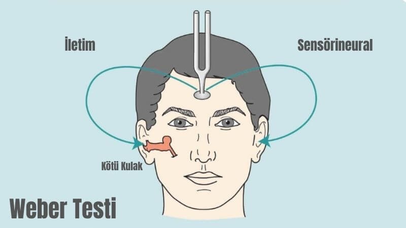 Weber Testi Nedir? Tanım, Köken ve Klinik Amaç
